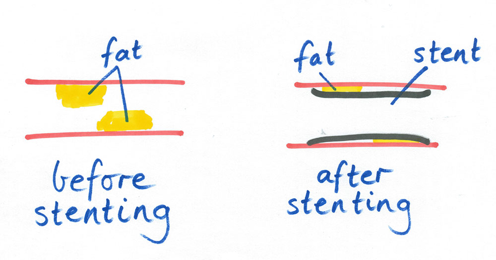 stenting